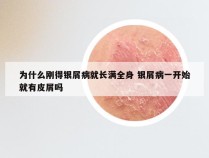 为什么刚得银屑病就长满全身 银屑病一开始就有皮屑吗