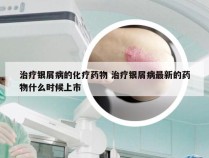 治疗银屑病的化疗药物 治疗银屑病最新的药物什么时候上市