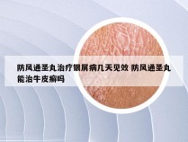 防风通圣丸治疗银屑病几天见效 防风通圣丸能治牛皮癣吗