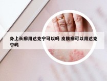 身上长癣用达克宁可以吗 皮肤癣可以用达克宁吗