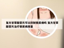复方甘草酸苷片可以控制银屑病吗 复方甘草酸苷片治疗银屑病用量