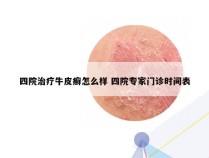 四院治疗牛皮癣怎么样 四院专家门诊时间表
