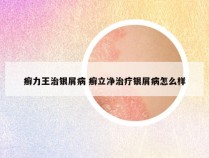 癣力王治银屑病 癣立净治疗银屑病怎么样