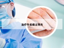 治疗牛皮癣土特方