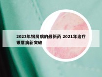 2023年银屑病的最新药 2021年治疗银屑病新突破