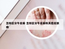 怎样区分牛皮癣 怎样区分牛皮癣和其他皮肤病
