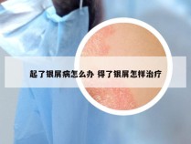 起了银屑病怎么办 得了银屑怎样治疗
