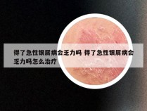 得了急性银屑病会乏力吗 得了急性银屑病会乏力吗怎么治疗