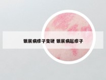 银屑病疹子变硬 银屑病起疹子