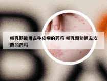 哺乳期能用去牛皮癣的药吗 哺乳期能擦去皮藓的药吗
