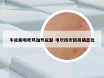 牛皮癣电吹风加热皮肤 电吹风吹银屑病患处