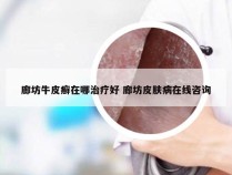 廊坊牛皮癣在哪治疗好 廊坊皮肤病在线咨询