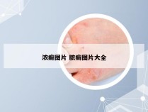 浓癣图片 脓癣图片大全