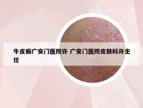 牛皮癣广安门医院许 广安门医院皮肤科许主任