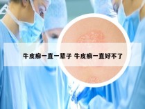 牛皮癣一直一辈子 牛皮癣一直好不了
