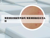 银屑病会接触性传染吗 银屑病接触后会怎么样