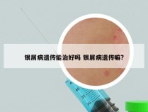 银屑病遗传能治好吗 银屑病遗传嘛?