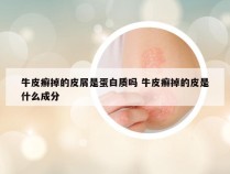 牛皮癣掉的皮屑是蛋白质吗 牛皮癣掉的皮是什么成分