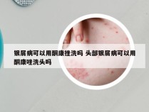 银屑病可以用酮康挫洗吗 头部银屑病可以用酮康唑洗头吗