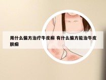 用什么偏方治疗牛皮癣 有什么偏方能治牛皮肤癣