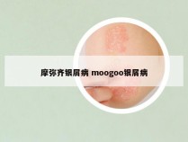摩弥齐银屑病 moogoo银屑病