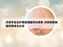 济南专业治疗银屑病医院在哪里 济南银屑病医院费用怎么样