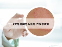7岁牛皮癣怎么治疗 六岁牛皮癣