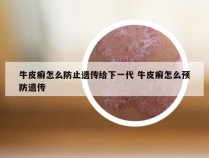 牛皮癣怎么防止遗传给下一代 牛皮癣怎么预防遗传