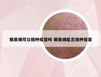 银屑病可以接种疫苗吗 银屑病能否接种疫苗