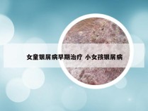 女童银屑病早期治疗 小女孩银屑病