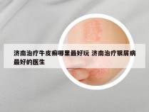 济南治疗牛皮癣哪里最好玩 济南治疗银屑病最好的医生