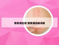 银屑病在线 银屑病动画讲解