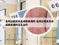 虫咬过敏皮炎会成银屑病吗 虫咬过敏皮炎会成银屑病吗怎么治疗