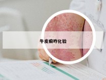 牛皮癣咋化验