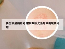 典型银屑病照光 银屑病照光治疗中出现的问题