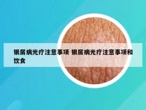 银屑病光疗注意事项 银屑病光疗注意事项和饮食