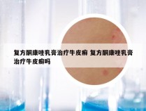 复方酮康唑乳膏治疗牛皮癣 复方酮康唑乳膏治疗牛皮癣吗