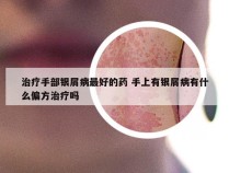 治疗手部银屑病最好的药 手上有银屑病有什么偏方治疗吗