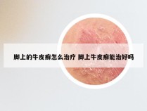 脚上的牛皮癣怎么治疗 脚上牛皮癣能治好吗
