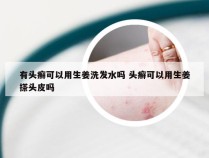 有头癣可以用生姜洗发水吗 头癣可以用生姜搽头皮吗