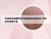 牛肉和羊肉哪种对牛皮癣患者危害更大 牛肉和羊肉哪个毒