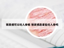 银屑病可以吃人参嘛 银屑病患者能吃人参吗