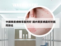 中国银屑病哪家医院好 国内银屑病最好的医院排名
