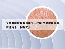 父亲有银屑病会遗传下一代嘛 父亲有银屑病会遗传下一代嘛女儿