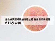 急性点滴型银屑病消退过程 急性点滴状银屑病多久可以消退