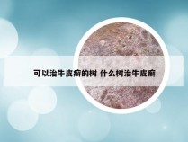 可以治牛皮癣的树 什么树治牛皮癣