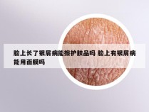 脸上长了银屑病能擦护肤品吗 脸上有银屑病能用面膜吗