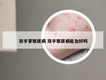 双手掌银屑病 双手银屑病能治好吗