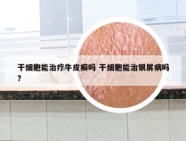 干细胞能治疗牛皮癣吗 干细胞能治银屑病吗?