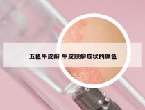 五色牛皮癣 牛皮肤癣症状的颜色